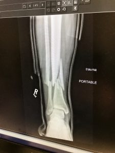 X-rays reveal the fractures sustained by pro snowboarder Jeremy Jones in a Jan. 11 accident in Utah. (photo: GoFundMe.com)