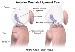 The dreaded ACL tear. (image: Bruce Blaus)