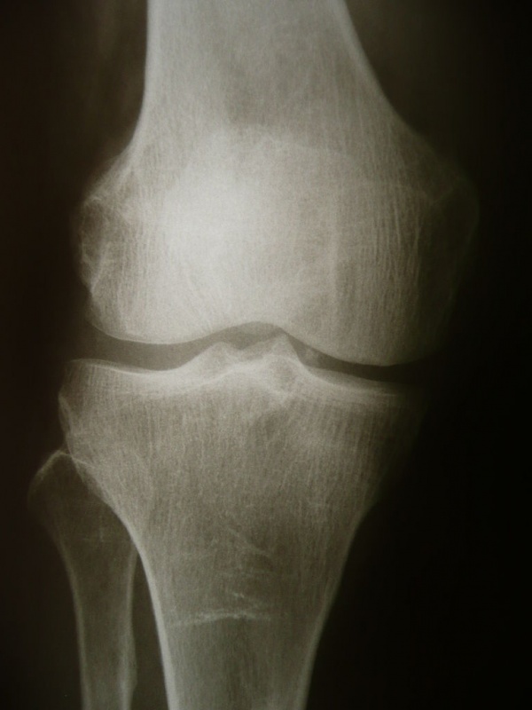 Strenghten Your Knees for Ski Season